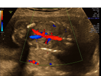 Unilateral renal agenesis color dopplers coronal